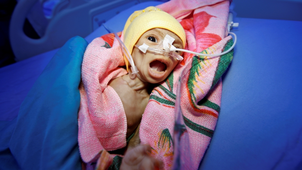 Sixty-day-old Nadia Ahmad Sabri, who suffers from severe malnutrition, lies in bed at a malnutrition treatment centre in Hodeidah [Abduljabbar Zeyad/Reuters]